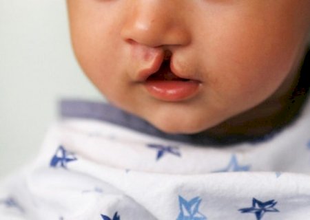 Programa estadual realiza primeira cirurgia de correção de fissura lábio-palatal