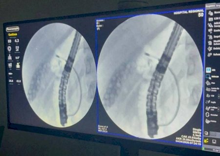 Exame inédito marca avanço da alta complexidade no Hospital Regional de Dourados
