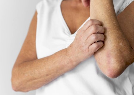 Dia Mundial da Alergia: anafilaxia e choque anafilático acendem alerta para formas mais graves das reações alérgicas